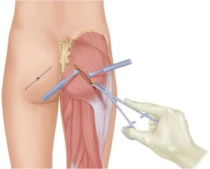 surgical cure piriformis syndrome